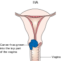 cancro collo dell'utero