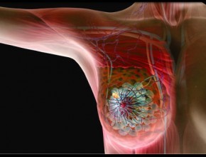 carcinoma mammario
