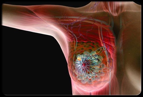 Illustrazione del tumore al seno