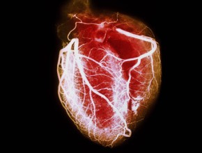 PRinc_rm_arteriogram_of_healthy_heart