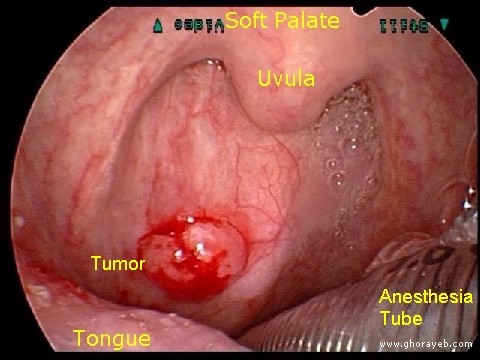 papilloma cancro gola