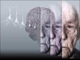 diagnosi Alzheimer