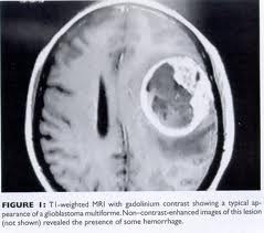 celulare e tumore al cervello