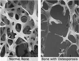 cause osteoporosi nella donna
