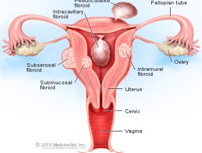 classificazione fibromi uterini
