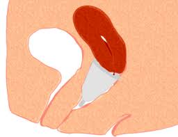 inserimento coppetta mestruale