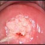 LESIONE DA HPV