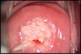 Papilloma virus con lesioni - Lesioni da papilloma virus