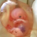 ABORTO