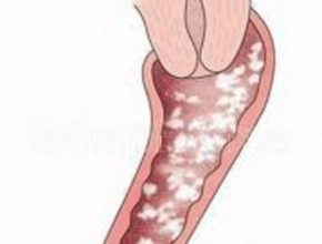 candidosi vaginale