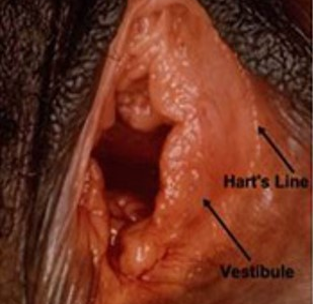 papilloma virus grandi labbra ghiduri clinice negi genitale