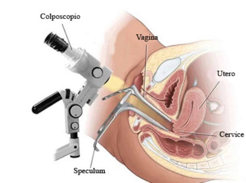 Colposcopia in caso di ASC-US