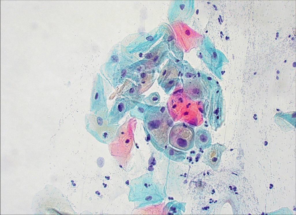 pap test